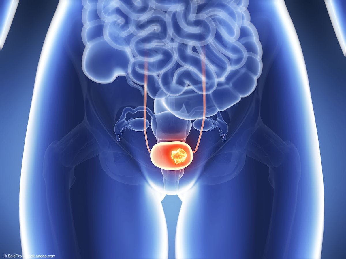 APL-1706 with blue light cystoscopy shows superiority in bladder cancer detection 