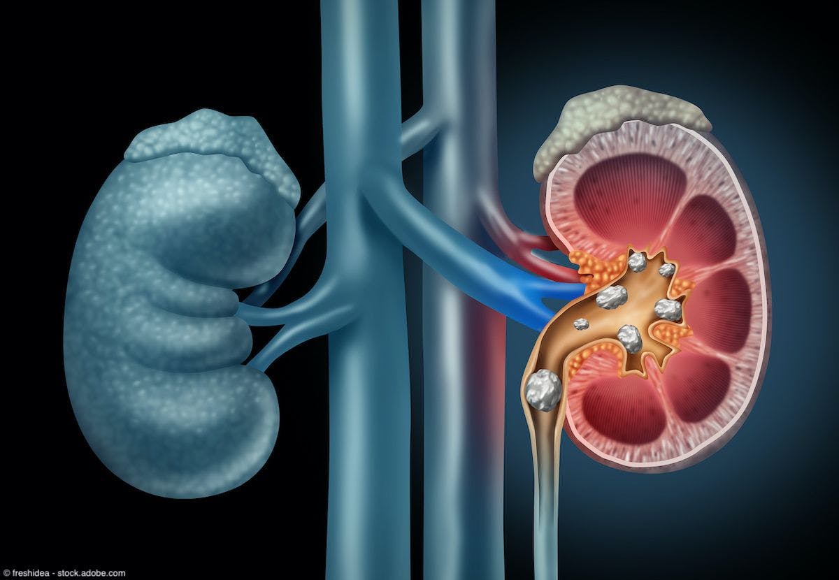  Novel approach shows efficacy in fragmenting kidney stones